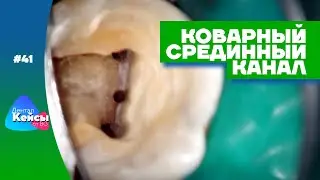 Коварный срединный канал | Дентал Кейсы от BG #41