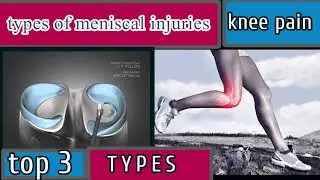 Meniscal injury types