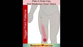 Pain in knee cap and weakness on stairs