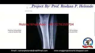 Bone Fracture Detection Using Image Processing With Source Code | Python Project Fracture Detection