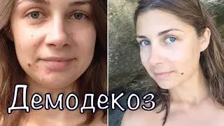 ДЕМОДЕКОЗ - ЛЕЧЕНИЕ мой опыт, косметика Demodex-Complex