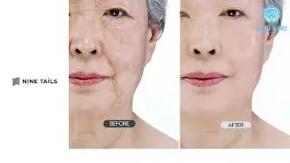 Nine Tails - Advanced Line Lift Serum (user 3) | HaruTube