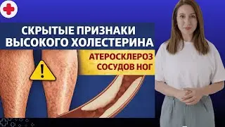 Your legs are screaming cholesterol! 5-minute self-diagnosis