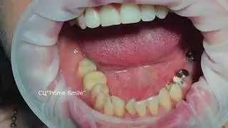 Фиксация металлокерамических коронок.