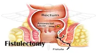 Low fistula in ano| Fistulectomy| Dr. Pandiaraja| Surgeon Pandiaraja
