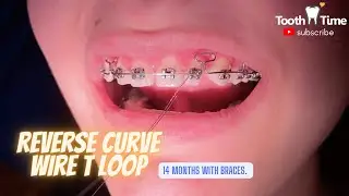 What does a reverse curve wire do for braces? Tooth Time Family Dentistry New Braunfels Texas