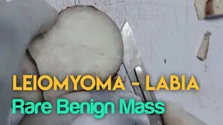 Leiomyoma - Labia, Rare Benign Mass - Dissection #essenceworld