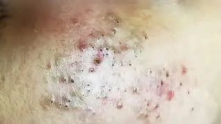 2024's Mind-Blowing Extreme Blackhead Removal