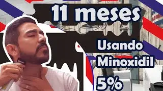 11 meses usando minoxidil 5%