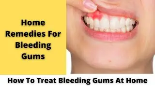 Stop Bleeding Gums | bleeding gums home remedy | Dental Care | Gingivitis