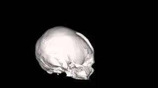 Skull - 3D Medical Model - Surgery for Cranioplasty - 234308