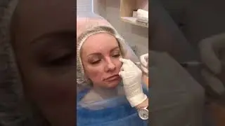 Увеличение скул филером в клинике Аура