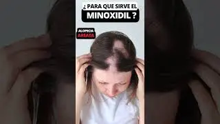 👉 Como CURAR la CALVICIE Areata👀👑✂️ #calviciefeminina #minoxidil #crecimientodecabello #alopecia