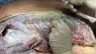 BACK LATISSIMUS DORSI TRAPEZIUS SERRATUS POSTERIOR RHOMBOIDS ERECTOR SPINAE TL Fascia– Sanjoy Sanyal