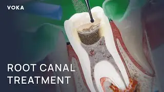 Root Canal Treatment | VOKA 3D medical animation