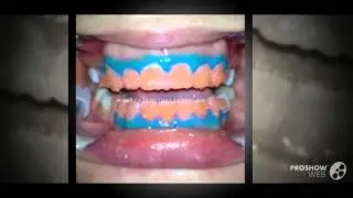 отбеливание зубов отзывы   - Как отбелить зубы дома