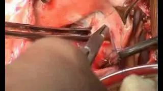 Repair of Rheumatic Tricuspid Valve Disease