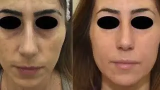 Dermamelan  - Macchie della pelle - Melasma