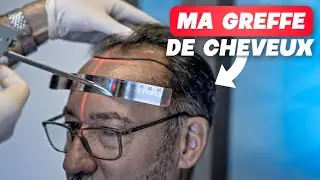 JE FILME MA CHIRURGIE ESTHETIQUE DE GREFFE DE CHEVEUX A ISTANBUL EN TURQUIE c'est vraiment fou !!!