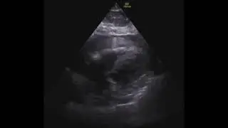 Hemopericardium
