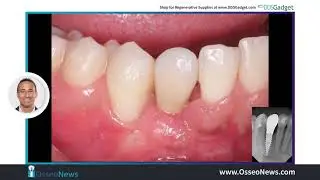 Improve GBR with an Amnion / Chorion Membrane