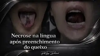 Necrose na língua após preenchimento do queixo