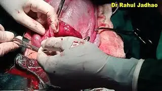 Uterine Closure with  Misgav Ladach technique