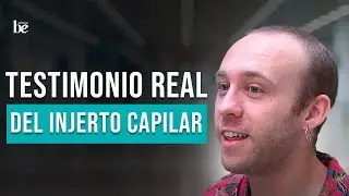 REAL TESTIMONIAL of Hair Transplant | ÁLVARO HUESO | Clínicas Be | Story of a Hair Transplant