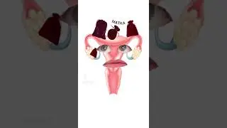 Endometrioz