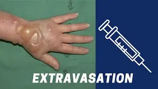 Extravasation | Radiotherapy Edutech | Common Terms in Oncology