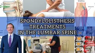 Spondylolisthesis Treatment Options in the Spine