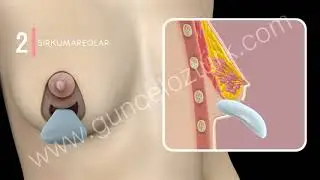 Göğüs dikleştirme ameliyatı nasıl yapılır ? (Meme kaldırma, büyütme) - Doç. Dr. Güncel Öztürk