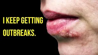3 Reasons Why You Get Back To Back HERPES OUTBREAKS