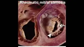 rheumatic mitral stenosis