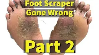 Foot Scraper Gone Wrong, Part 2