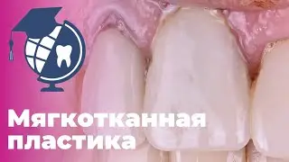 Мягкотканная пластика. Пластика мягких тканей в области имплантата в эстетически значимой зоне.Этапы