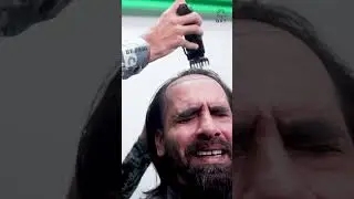 Amazing Hair Transplant Surgery | Latest Fue Technique 
