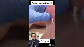 DOCTOR REACTS TO FOOT PIMPLE EXTRACTION!😱 #shorts #reaction