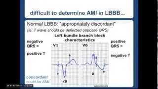 Sgarbossa Criteria - 