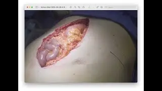 Perforator preserving anterior component release through lateral incisions