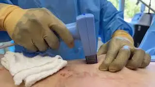 Morpheus8 torso in surgery