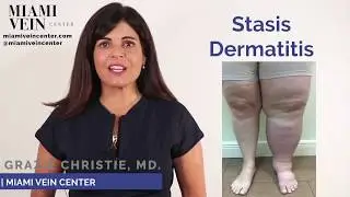 About Stasis Dermatitis Leg Discoloration