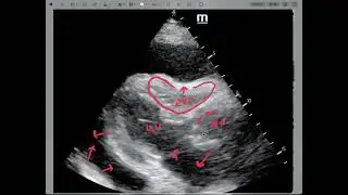 Cardiac US effusion and tamponade podcast