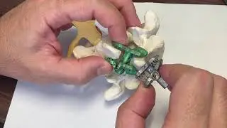 How to remove Sea Spine Posterior spinous process plates.