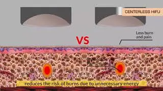 info 3D H**F CENTERLESS TECHNOLOGY