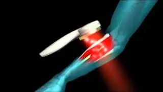 QVC SKN A222333 Nuve Arm Penetration 1