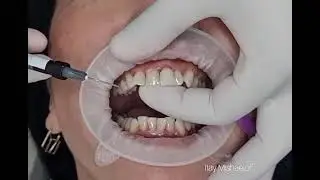 Misaligned teeth