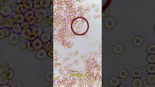 White blood cells fight infection under the microscope! RARE FOOTAGE!