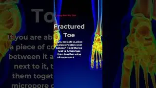 :🦶 Broken a Toe? Here’s How to Protect It Until You Get Medical Help! 🩹