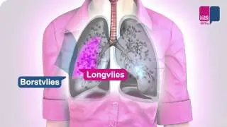 Pleuritis - wat gebeurt er in je longen?